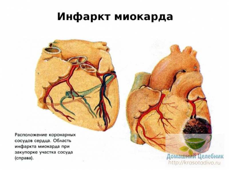 Этот рецепт поставил меня на ноги после инфаркта. Прошло уже 20 лет, а чувствую себя прекрасно