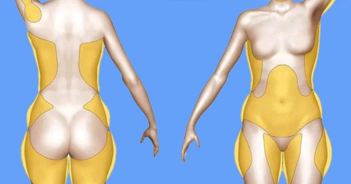 Почему скапливаются жиры в области подмышек, талии, ногах, бедрах, рук и спине