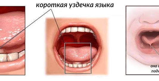 Короткая уздечка языка — что делать? Короткая уздечка языка — что делать?