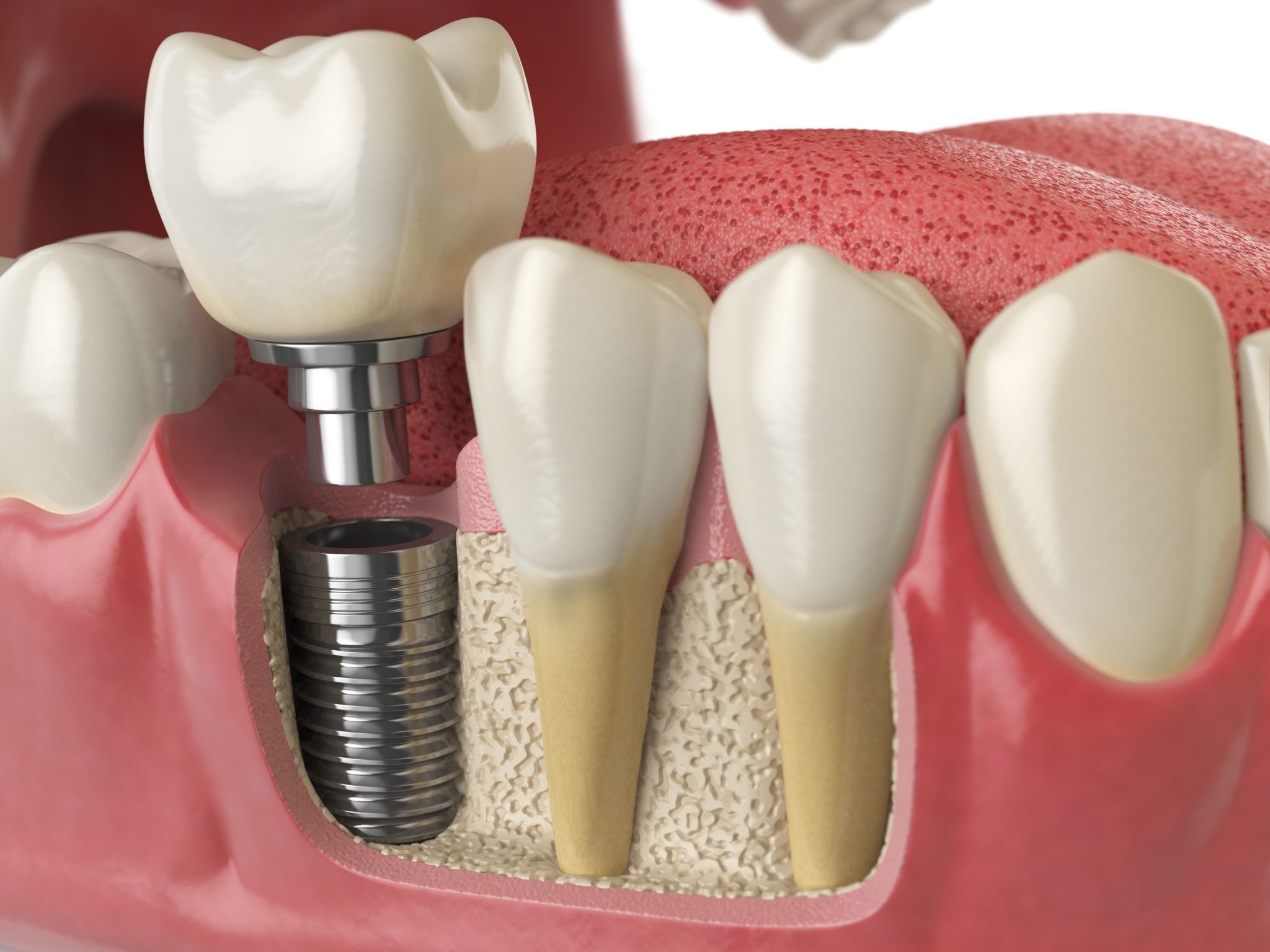 Когда требуется имплантация зубов и как она проходит