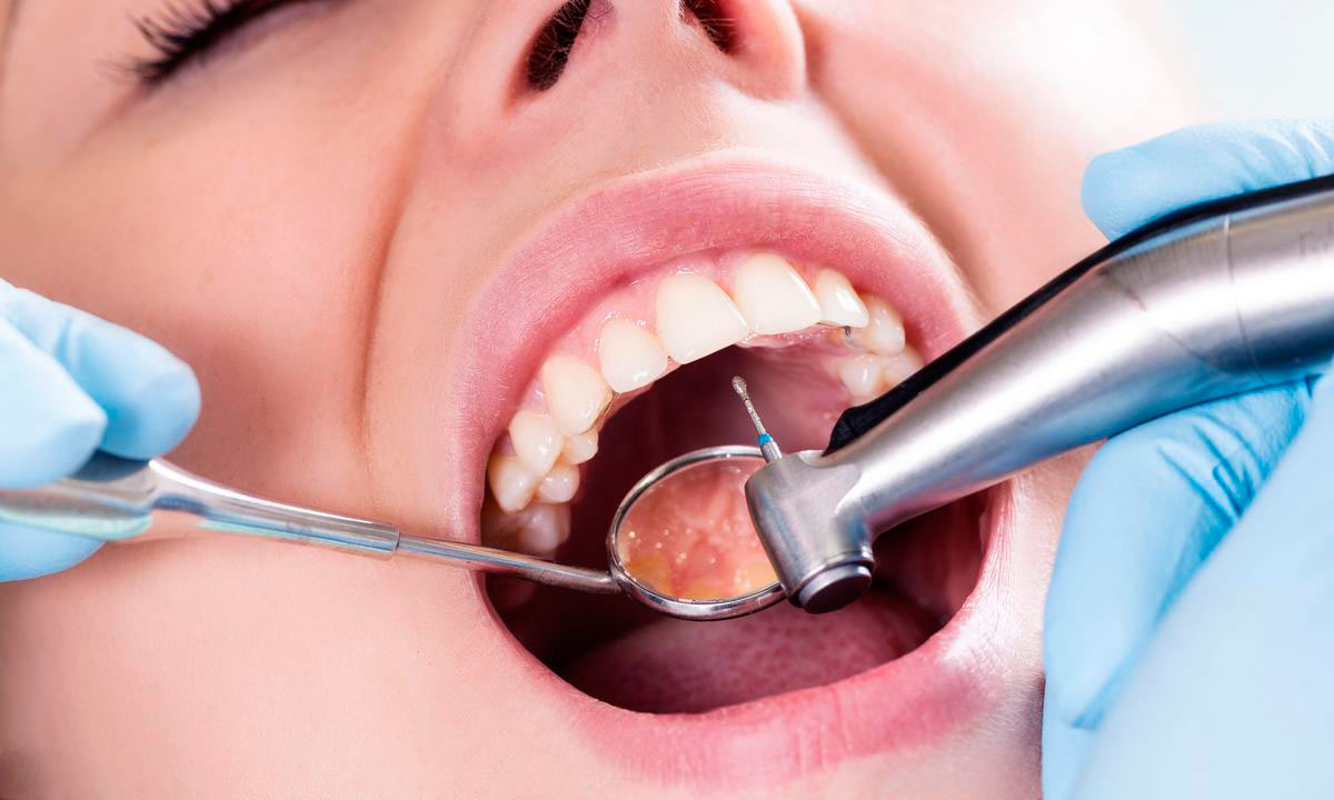 Кариес зубов: что это такое и как его лечить?
