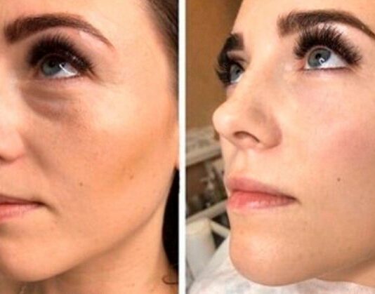 Носослёзная борозда: коррекция филлерами Носослёзная борозда: коррекция филлерами