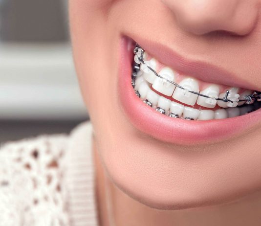 Когда нужно ставить брекеты?