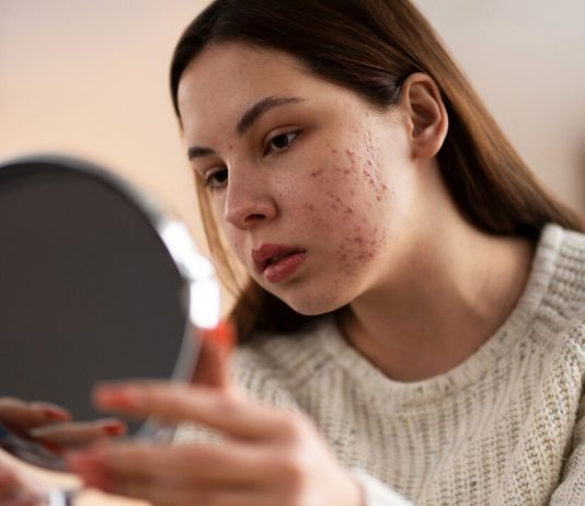 Современные методы лечения акне