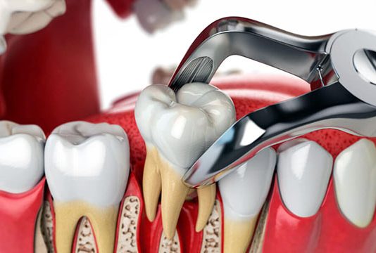 Удаление зуба без боли: современные методы анестезии