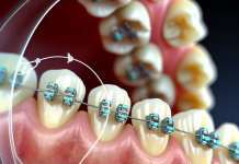 Керамические брекеты: устройство, плюсы и минусы, уход и сравнение с аналогами