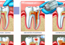 Лечение каналов зуба: этапы, методы, осложнения, особенности лечения разных зубов